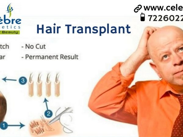 Hair-Transplant-in-Surat