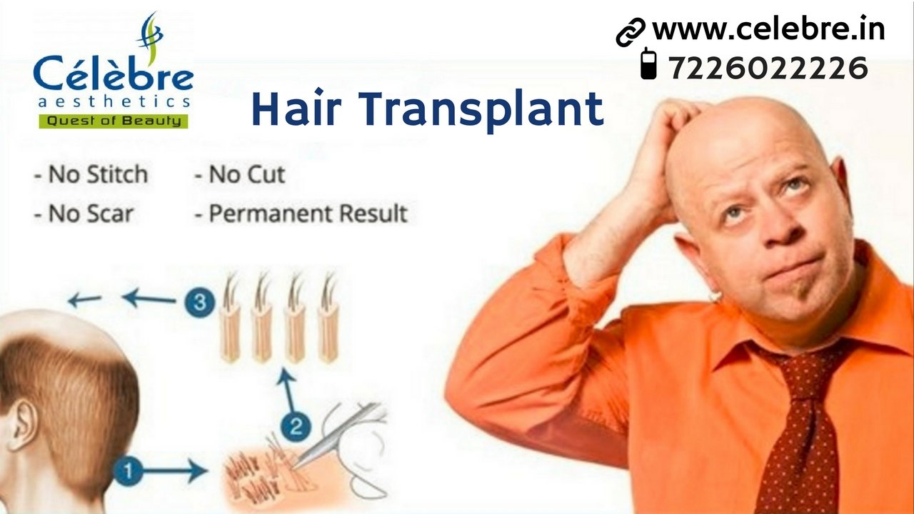 Hair Transplant in Surat