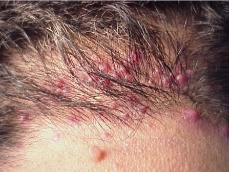 Scalp Infection