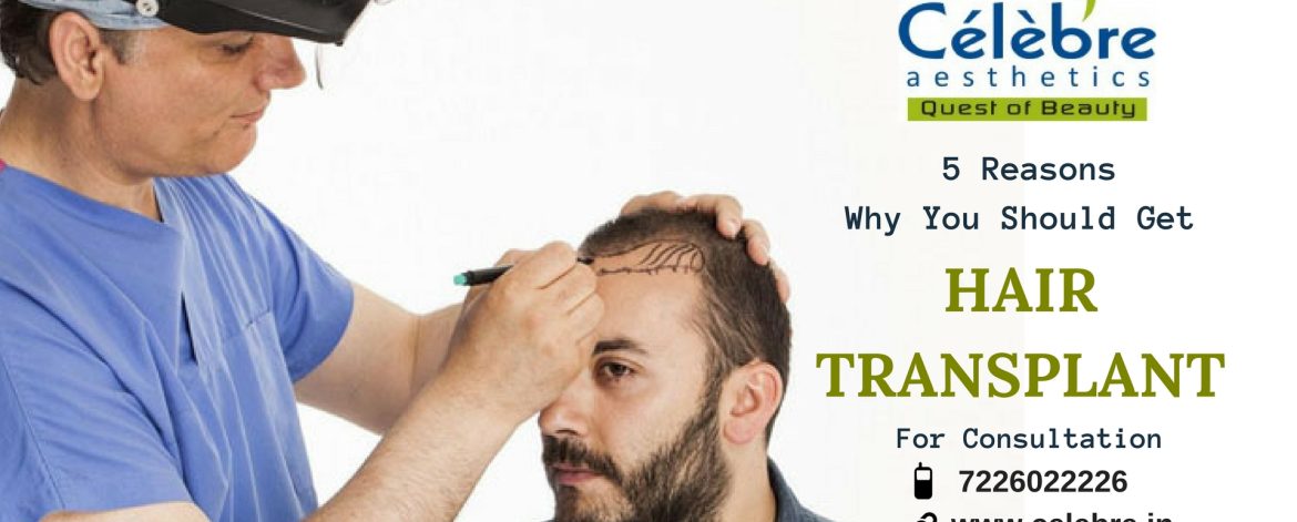 5-Reasons-Why-should-get-hair-transplant
