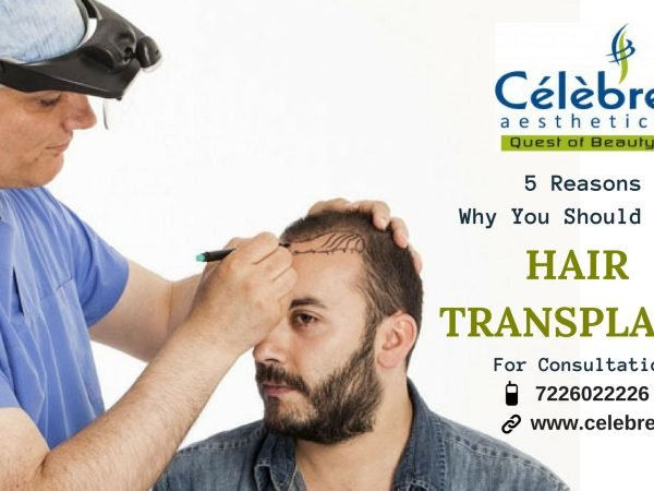 5-Reasons-Why-should-get-hair-transplant