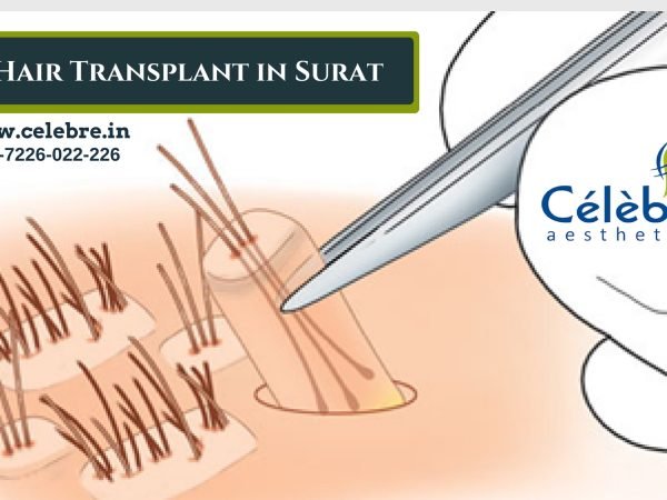 Best-Hair-Transplant-in-Surat