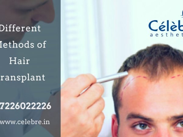 Different-Methods-of-hair-Transplant-1