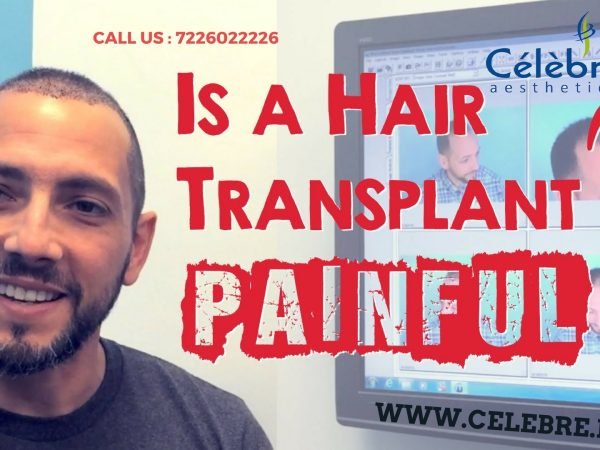 Is-a-hair-transplant-painful-