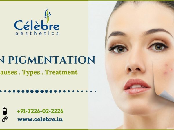 Skin-Pigmentation-Causes-Types-and-Treatment-in-Surat