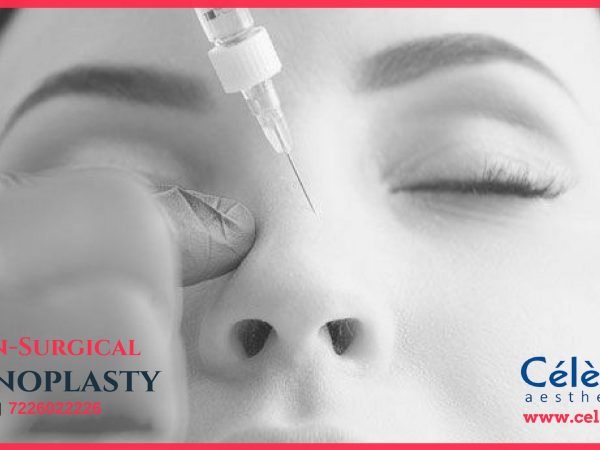 Non-Surgical-Rhinoplasty-in-Surat