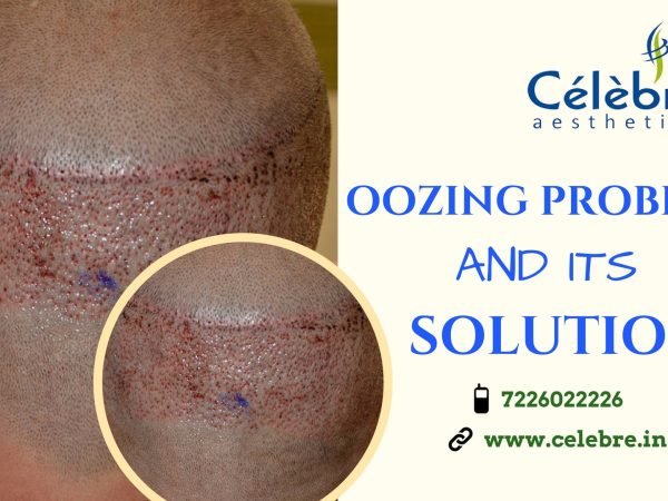 Solution-for-Oozing-Problem-After-Hair-Transplantation