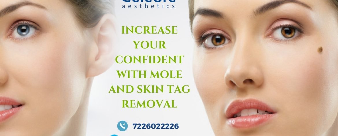 Increase-Your-Confident-With-Mole-and-Skin-Tag-Removal-min