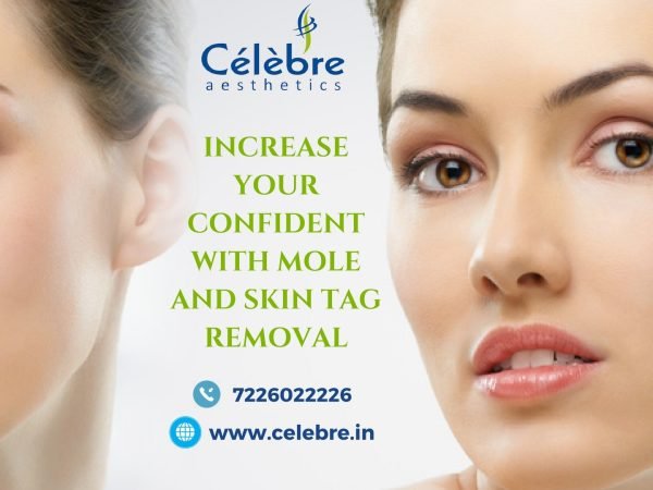 Increase-Your-Confident-With-Mole-and-Skin-Tag-Removal-min