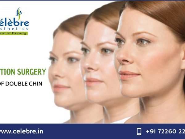Liposuction-Surgery-in-Surat