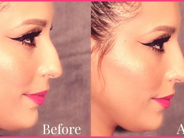 Non-Surgical-Nose-Job-treatment-in-Surat