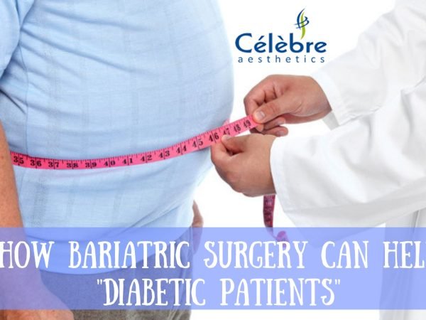 Bariatric-Surgery-in-Surat