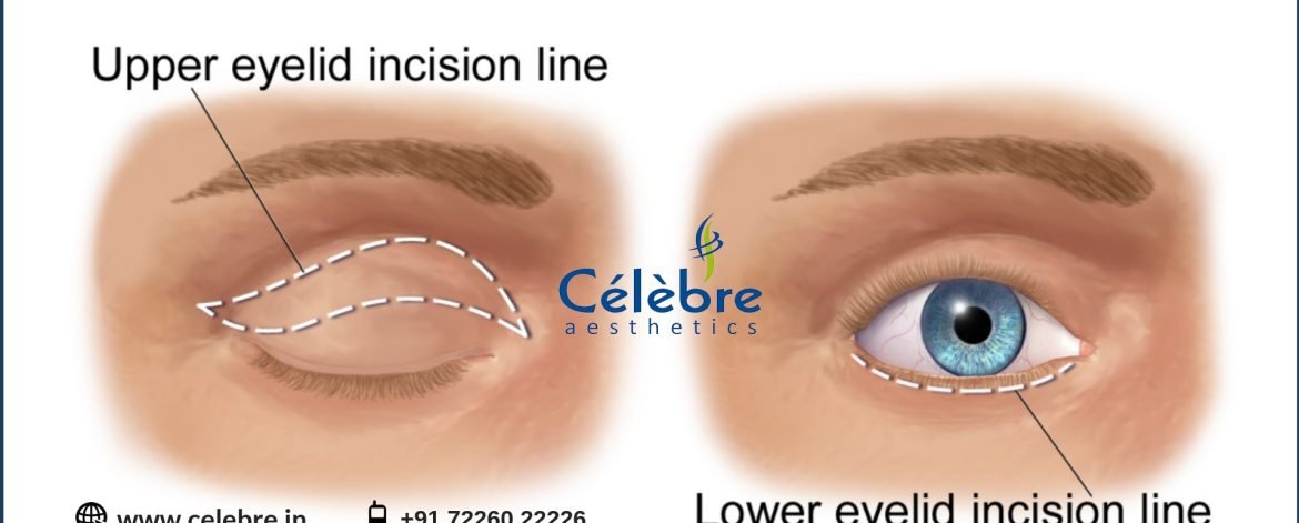 Eyelid-Surgery-and-After-Care