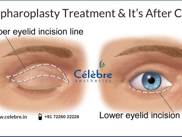 Eyelid-Surgery-and-After-Care