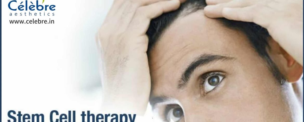 Stem-Cell-Therapy-for-Hair-Loss