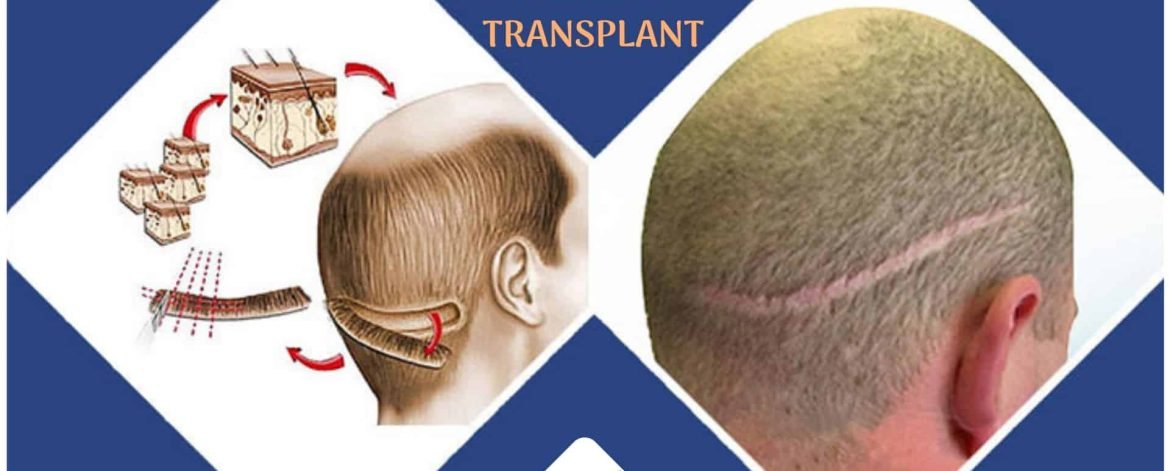 Busting-the-Myths-about-FUT-hair-transplant