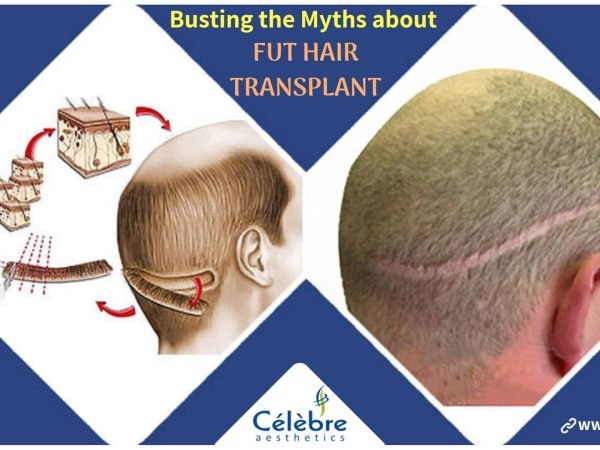 Busting-the-Myths-about-FUT-hair-transplant