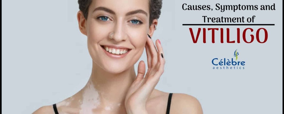 Vitiligo-Treatment