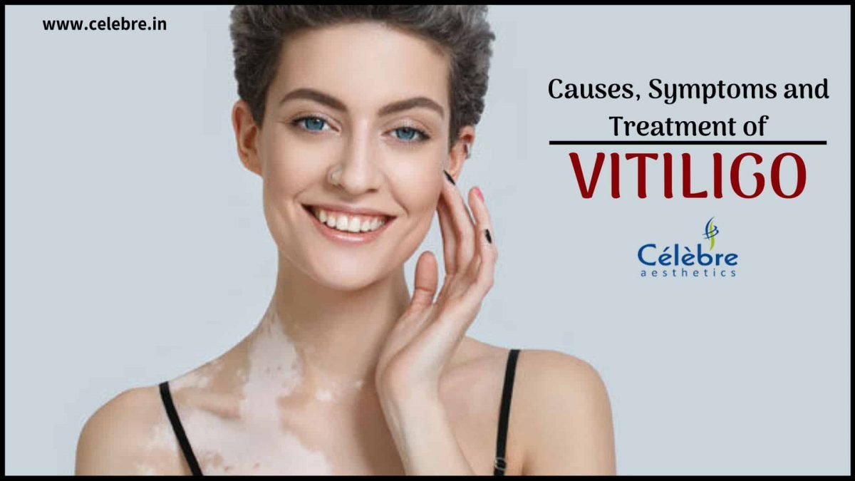 Vitiligo : Causes, Symptoms and Treatment | Celebre Aesthetics | Surat ...