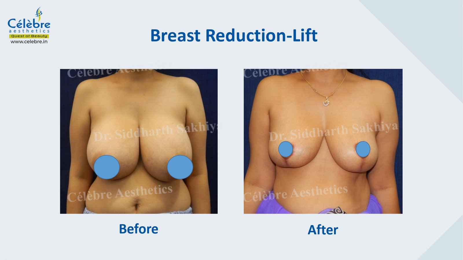 Best exercise after breast reduction surgery - Dr. Srikanth V 