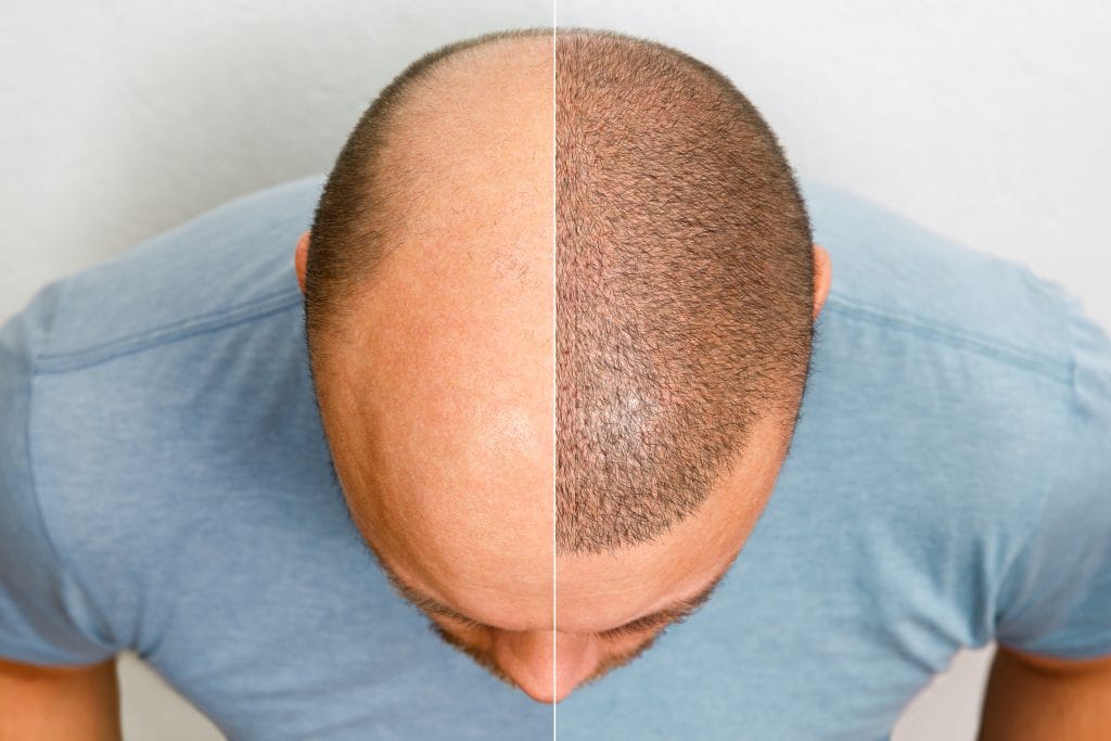 Hair transplant in India