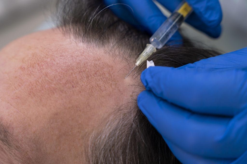 Hair transplant in India, Surat, Gujharat