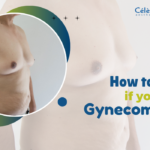 how to know if you have gynaecomastia