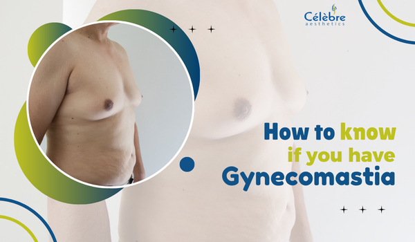 how to know if you have gynaecomastia