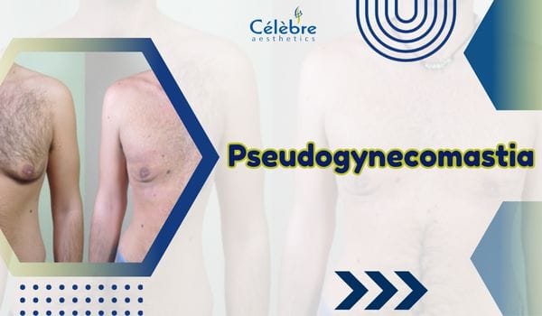 Pseudogynecomastia
