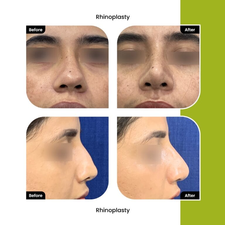 Nose reduction Surgery