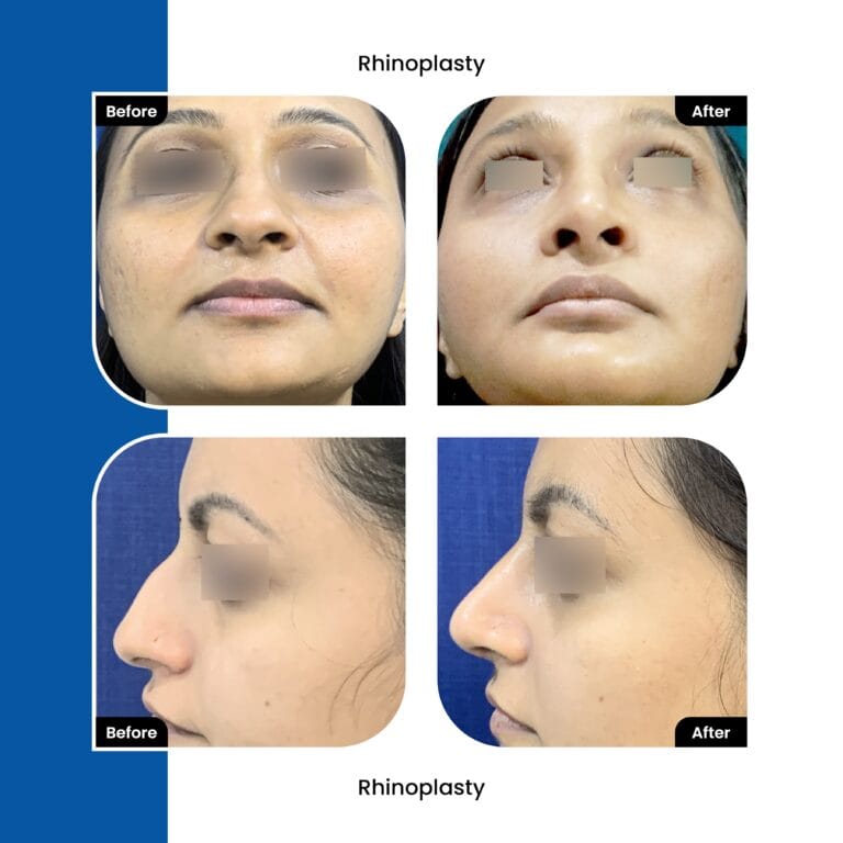 Rhinplasty-surgery