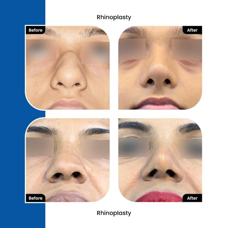 Nose Treatment