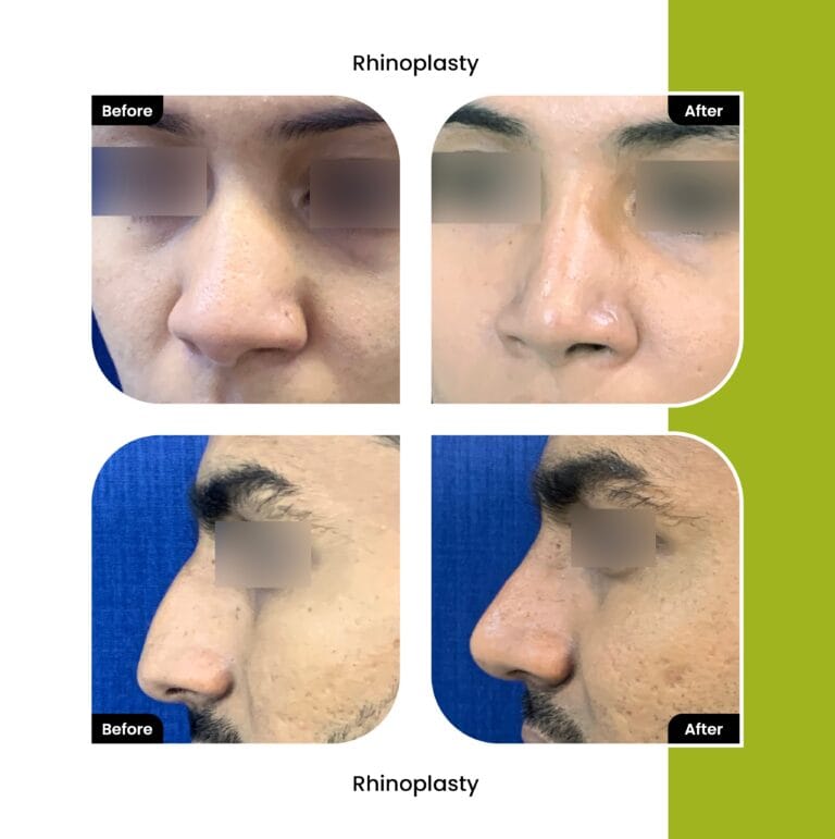 Nose Job
