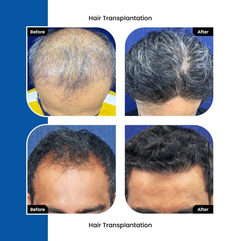 FUT Hair Transplant