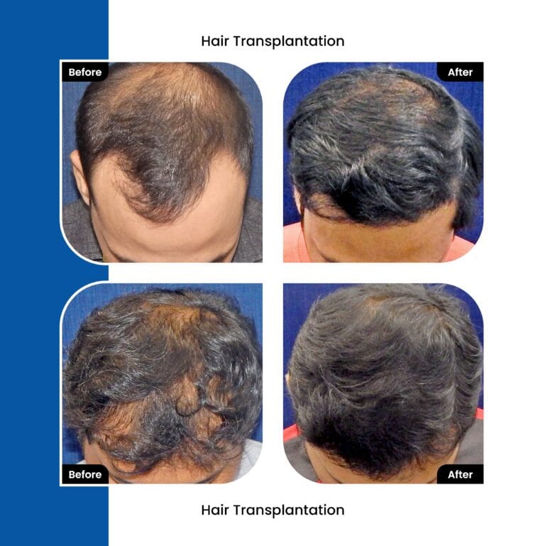 hair transplant results